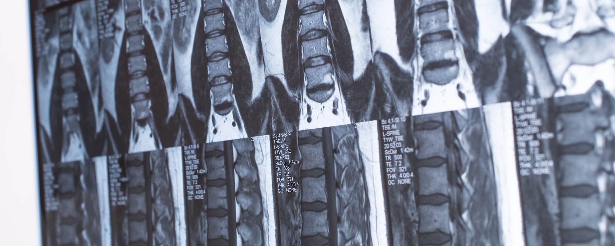 lumbar spine mri is not recommended for non-specific low back pain