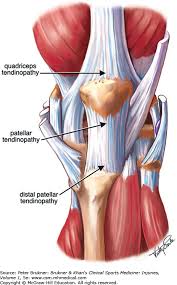 Jumper'S Knee patellar tendinopathy jumper's knee