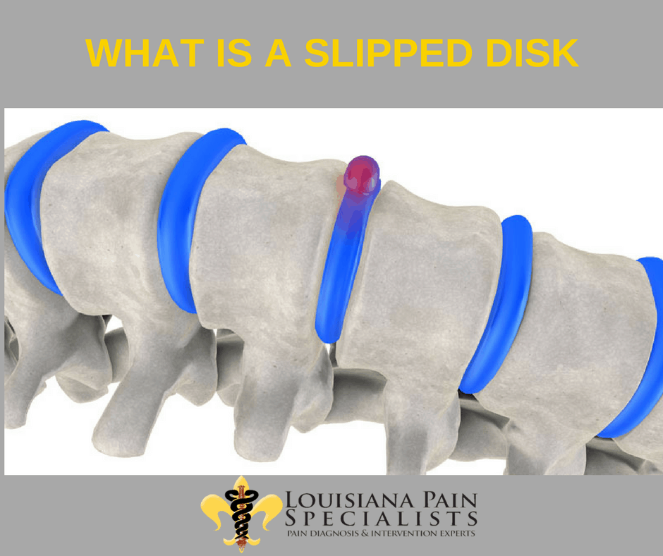 whatisaslippeddisklouisianapainspecialist Adelaide West Physio + Pilates Headache Clinic