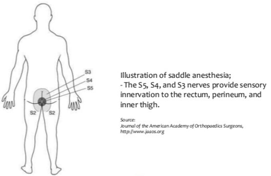 saddle paraesthesia is a symptom of cauda equina syndrome