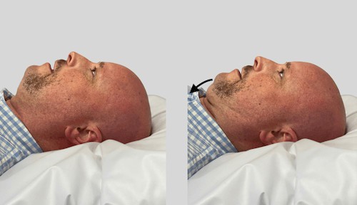 Craniocervical flexion is a great exercise for deep neck flexors and stretching tight suboccipital muscles