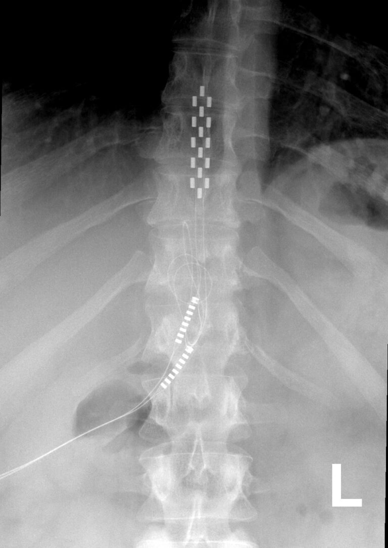 anterior thoracic scs back surgery