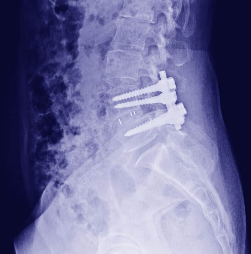 lumbar fusion surgery controversy back surgery
