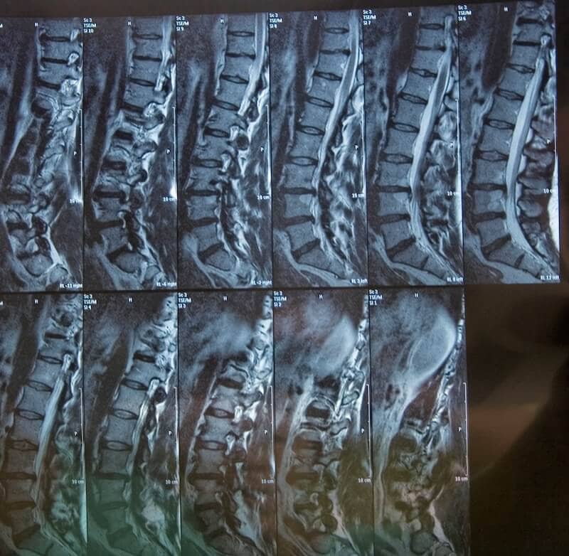 mri is used as part of spinal surgery