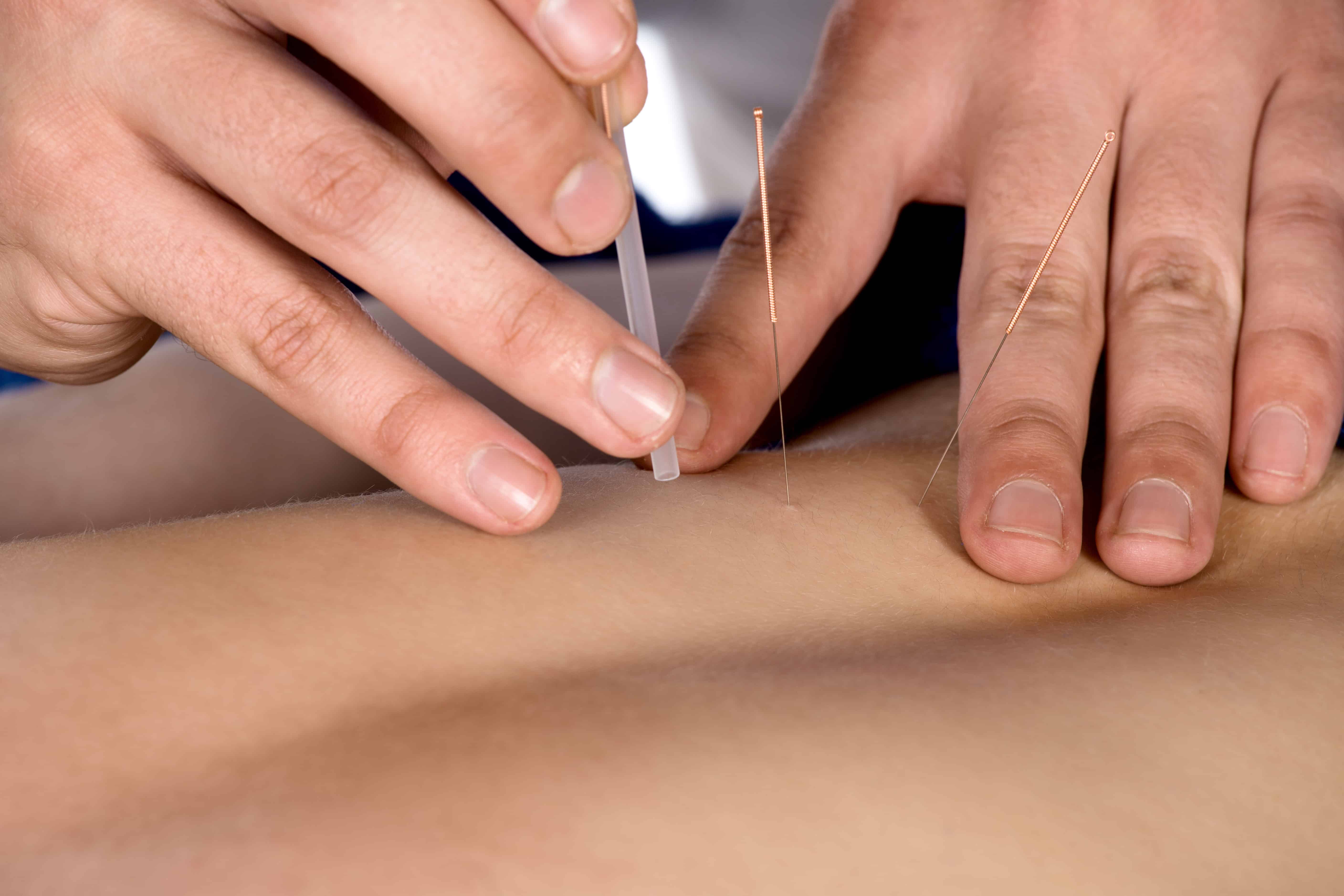 Dry needling is an effective treatment to reduce pain and muscle tightness