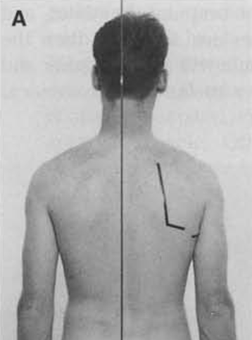 Shoulder depression and lengthened upper trapezius