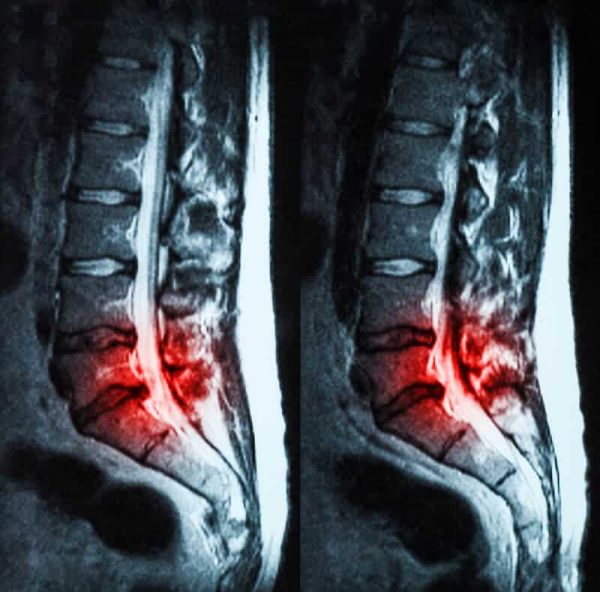 Imaging for low back pain must be approached with caution