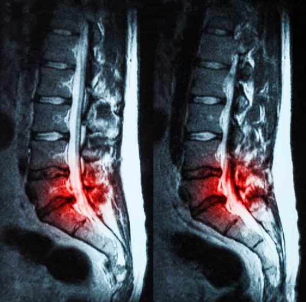 imaging for low back pain must be approached with caution