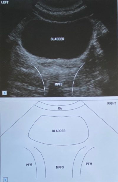 Real Time Ultrasound Imaging is a tool to help the women's health physio with pelvic floor strengthening and retraining